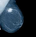 171_breastCancer