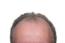 375-Dont_Transplant_Grow_Hair