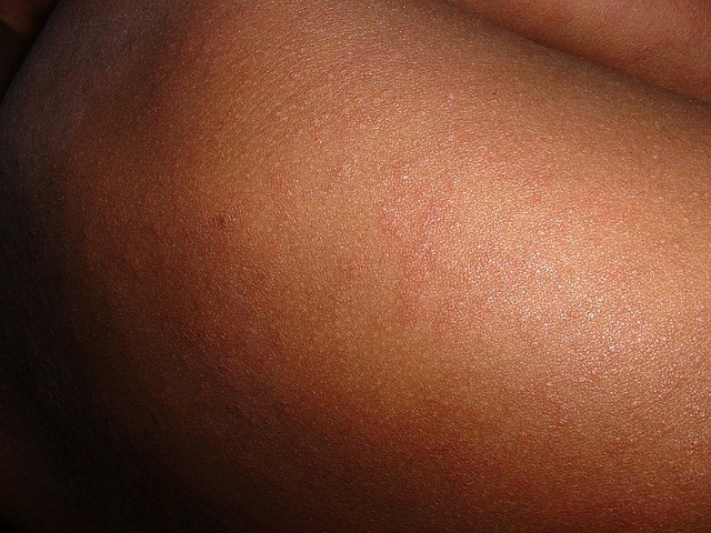 981 Measles - it shouldnt be back measles spots on skin