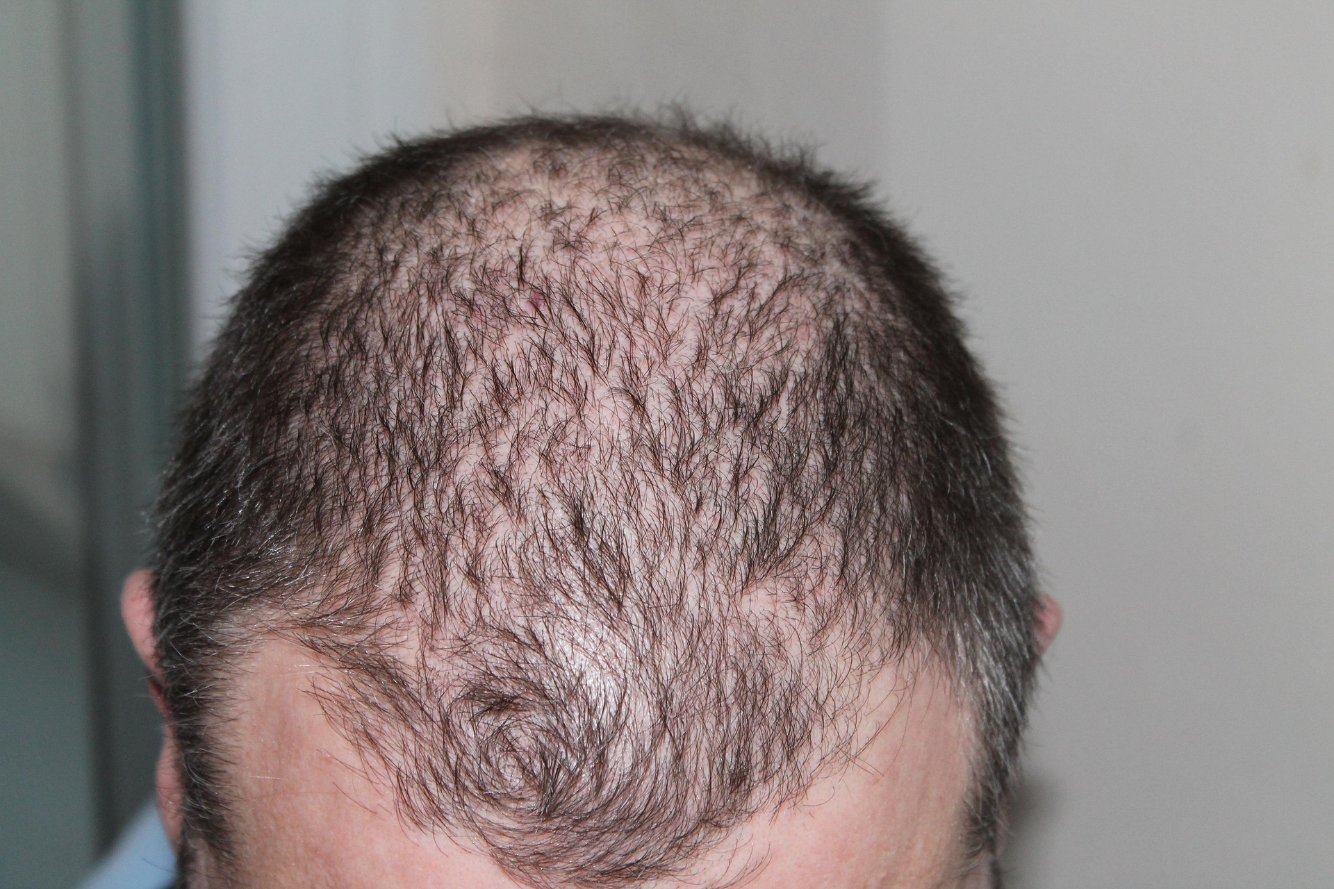 person's scalp with thinning hair