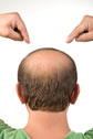 hairLoss
